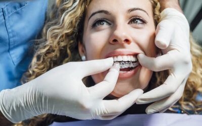 Invisalign and Self-Care: A Lifestyle Upgrade