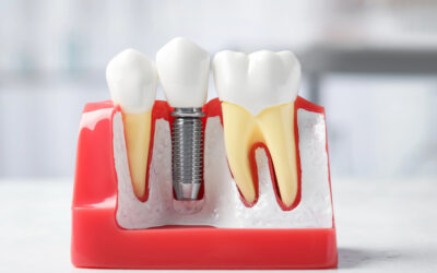 Dental Implants and Longevity: Can Teeth Extend Life Quality?