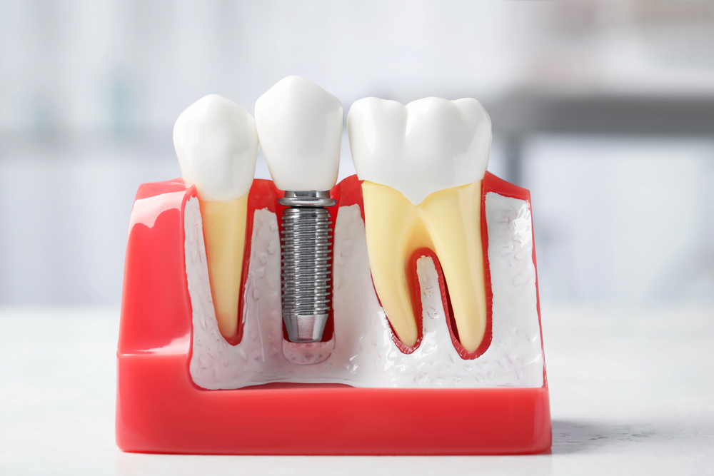 Dental Implants and Longevity: Can Teeth Extend Life Quality?