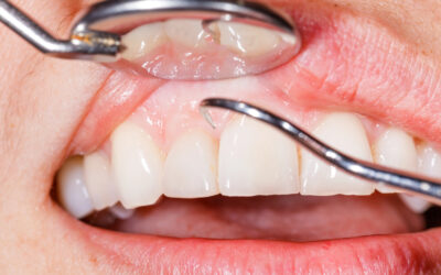 Gum Treatment as Preventive Medicine: Protecting More Than Just Teeth