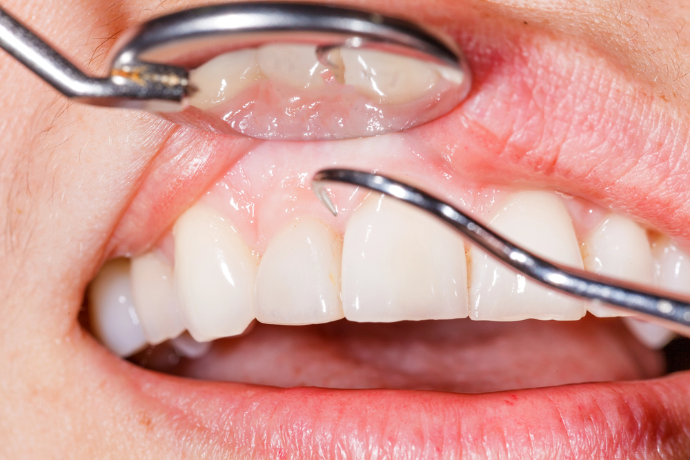 periodontal and gum treatment